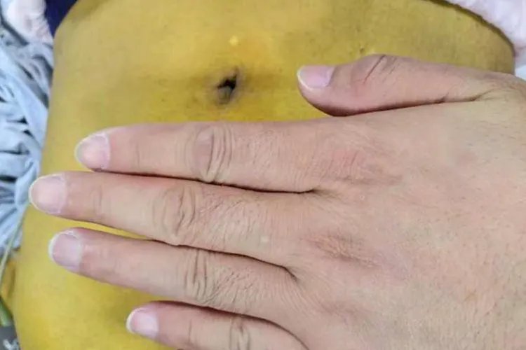 胆囊炎的症状是什么样的