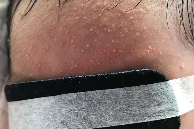 痤疮是什么图片