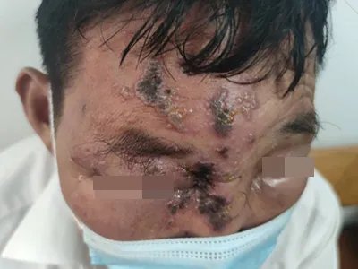 带状疱疹面部黑痂图片