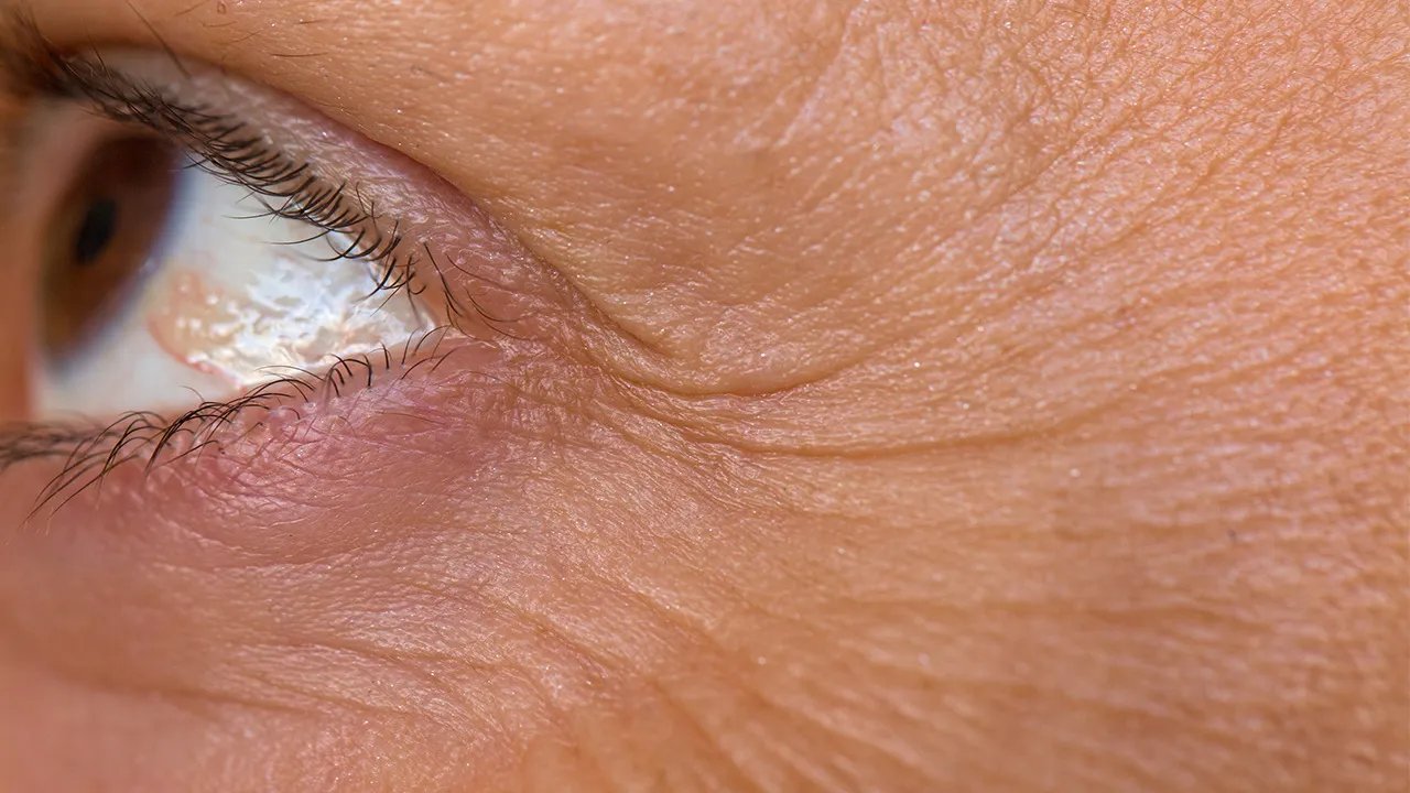 怎样去掉脸上皱纹