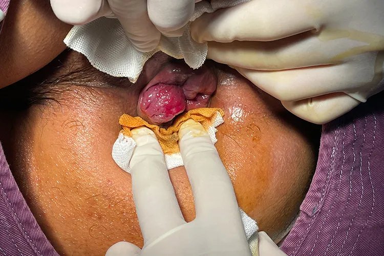 有痔疮是什么样的状况