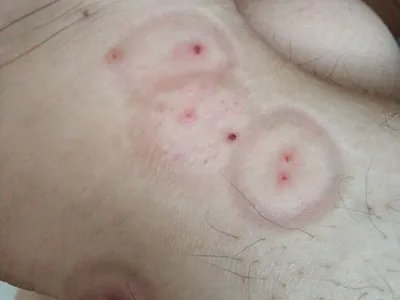 跳蚤叮咬红点图片