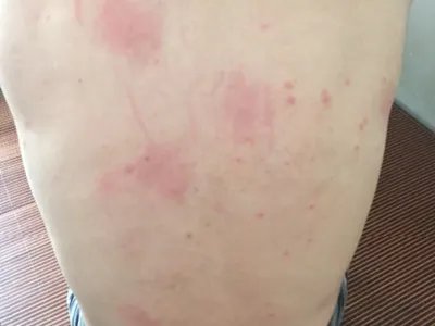 跳蚤叮咬红点图片