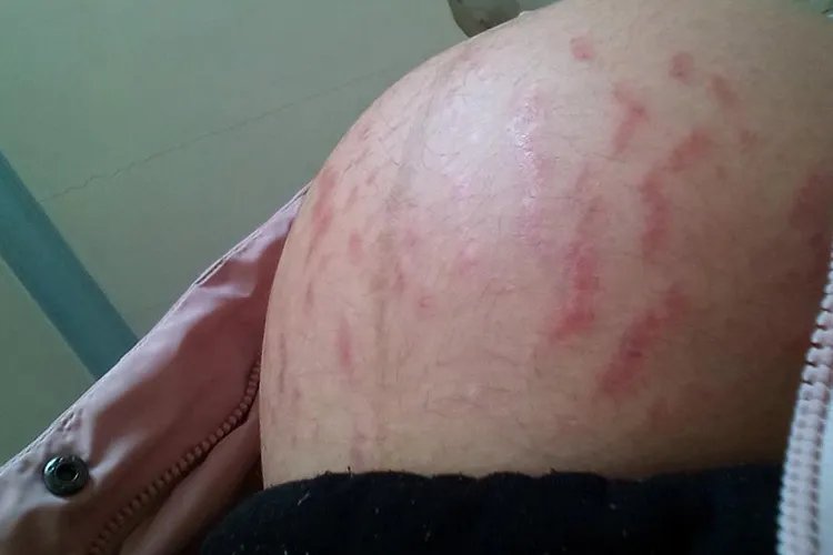 红色妊娠纹图片