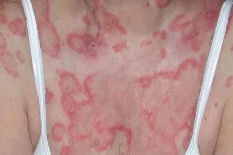 红斑狼疮是什么症状图