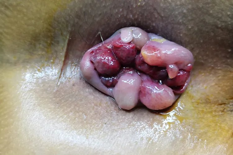 有痔疮是什么样的状况