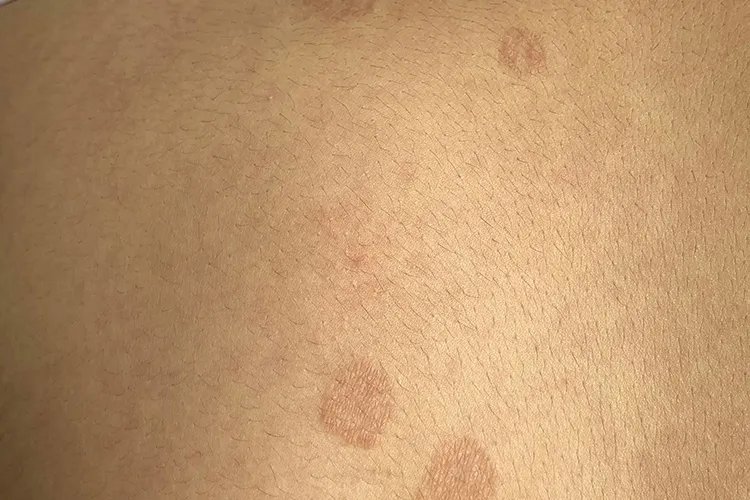 花斑癣图片危害