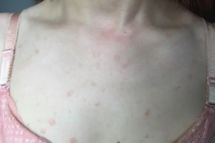 汗斑图片和症状图片