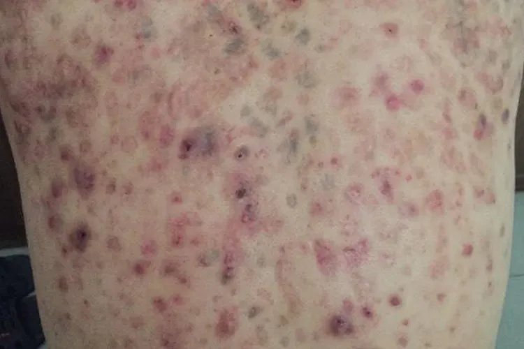 痤疮是什么图片