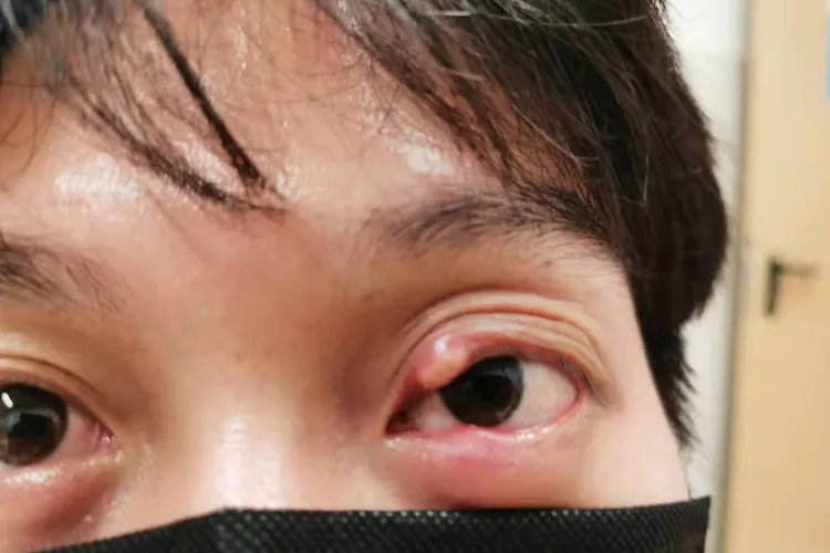 眼睛长了麦粒肿图片