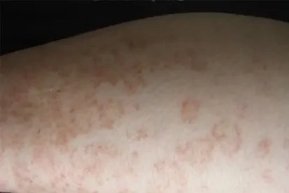 色素性紫癜性皮炎初期图片