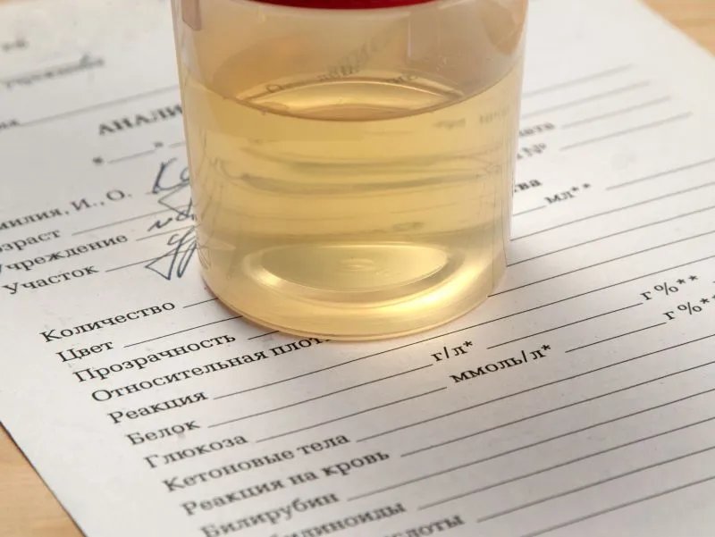 尿检中neg是什么意思