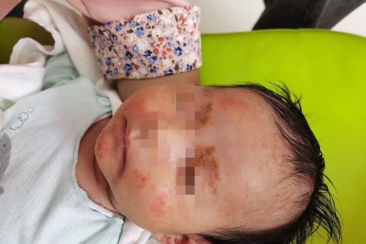 婴儿湿疹图片和症状