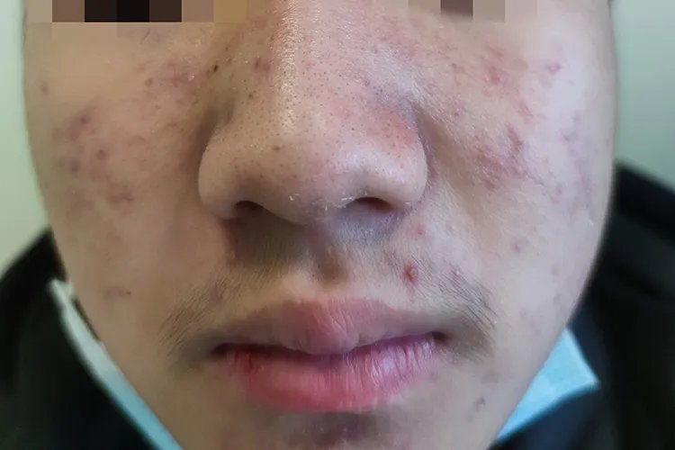 脸上长痘痘位置图解