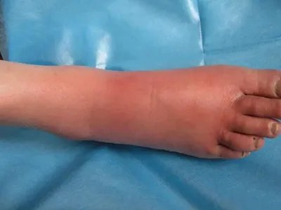 急性网状淋巴管炎脚背症状图片