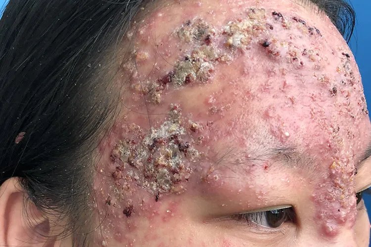 闭口痘痘长什么样子