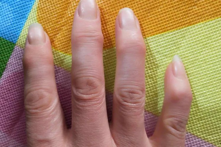 红斑狼疮是什么症状图