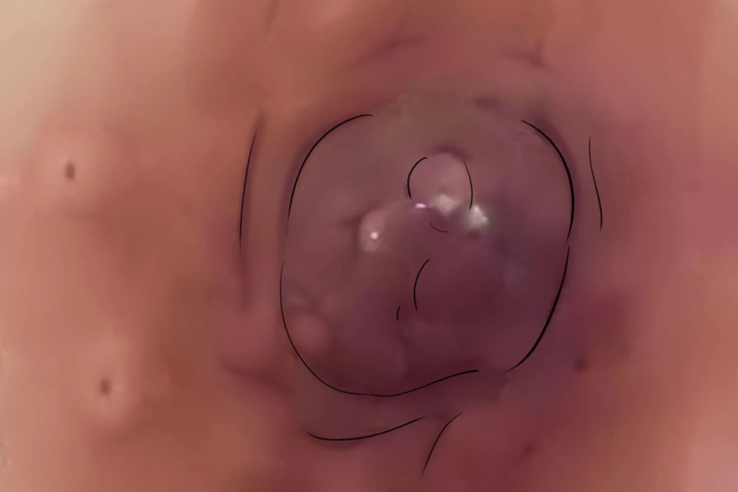 乳腺癌外观图片大全