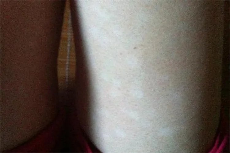 大腿汗斑癣图片大全