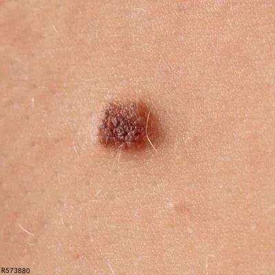 祛痣有哪些方法 这几种祛痣方法常用