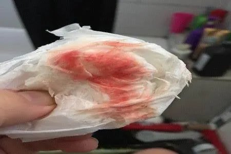 宫颈癌早期症状图片