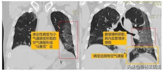 为什么湖北新增病例突增14840例？临床诊断病例是什么？