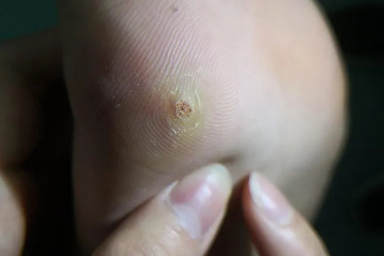 什么是寻常疣图片大全