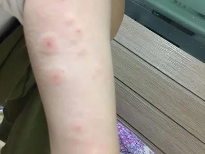 跳蚤叮咬红点图片