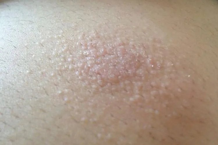 热痱子是什么样图片