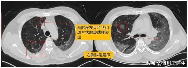 为什么湖北新增病例突增14840例？临床诊断病例是什么？