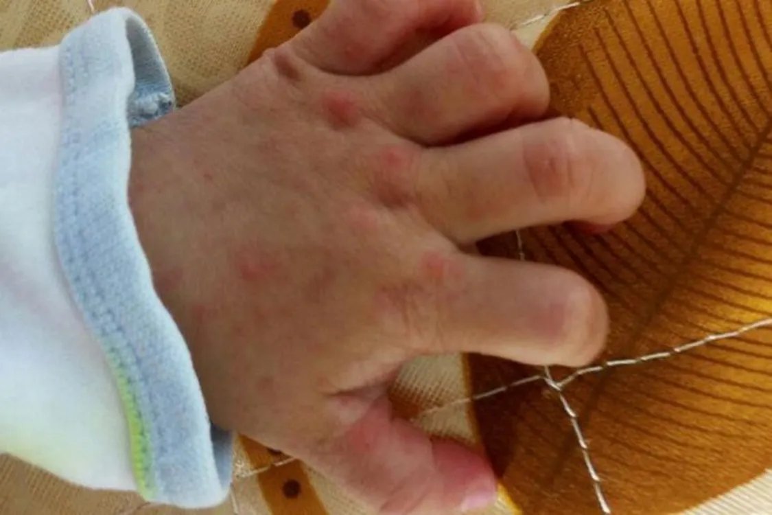 手足口病疹子图片