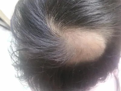 拔毛癖头皮症状图片