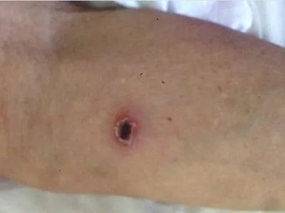 恙虫病焦痂图片