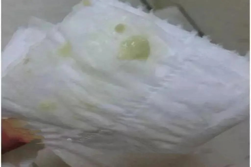 宫颈癌早期症状图片