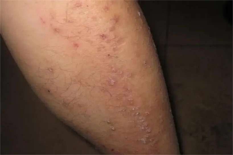 腿上的皮炎图片
