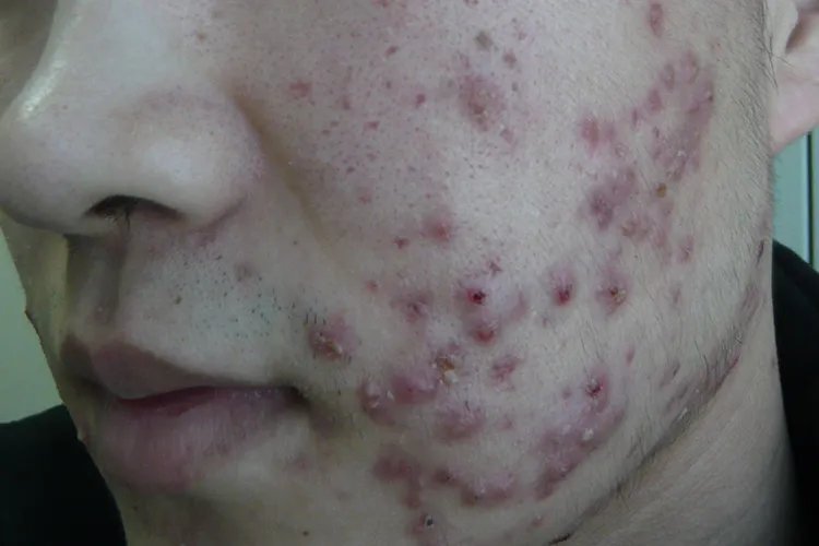 闭口痘痘长什么样子