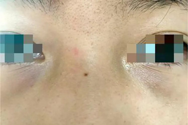 黑素细胞痣鼻部黑痣图片