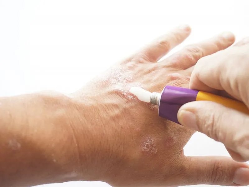 酮康唑乳膏是什么