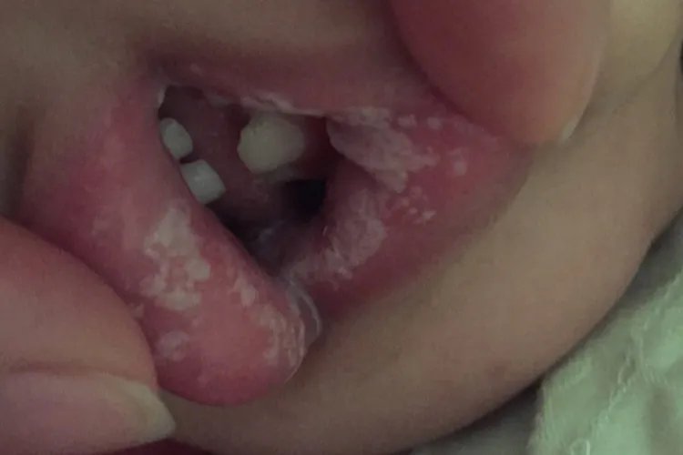 两岁宝宝鹅口疮图片