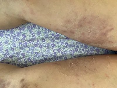 湿疹大腿症状图片