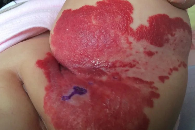 血管瘤是什么颜色的图片