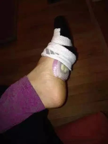 洋葱放入耳朵一夜奇迹出现了（图）