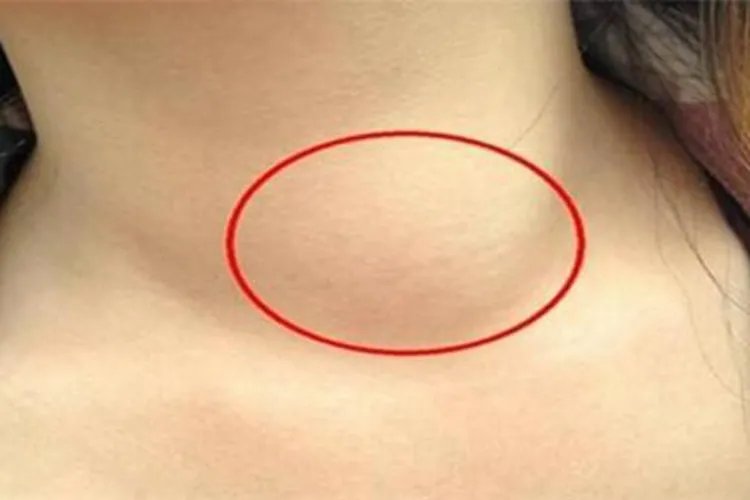 淋巴瘤早期图片大全