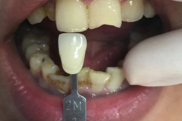 门牙补牙过程图解