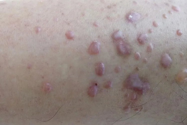 红斑狼疮是什么症状图