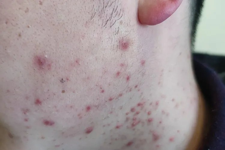 脸上长痘痘位置图解