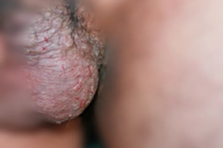 阴囊湿疹症状图片