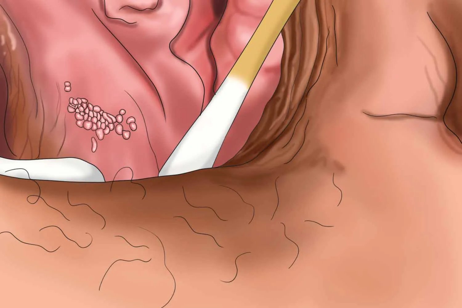 菜花状假性疣高清图片