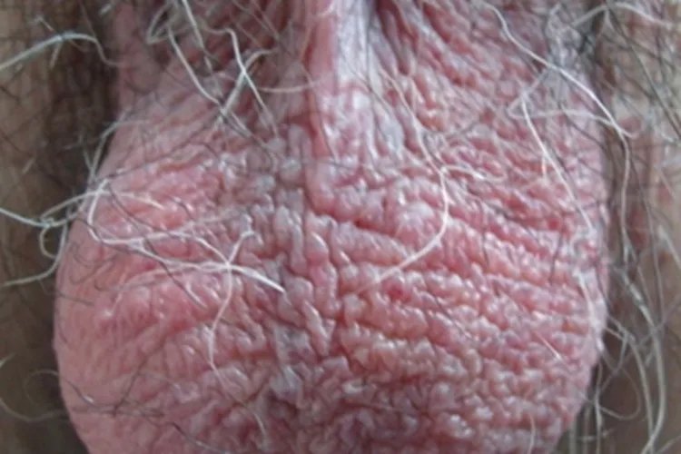 阴囊湿疹症状图片