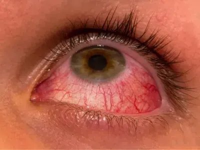 红眼病症状图片